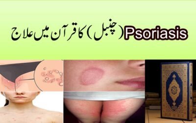 Chambal Ka 100% Ilaj Naqsh Se | Psoriasis Ka Ilaj In Quran